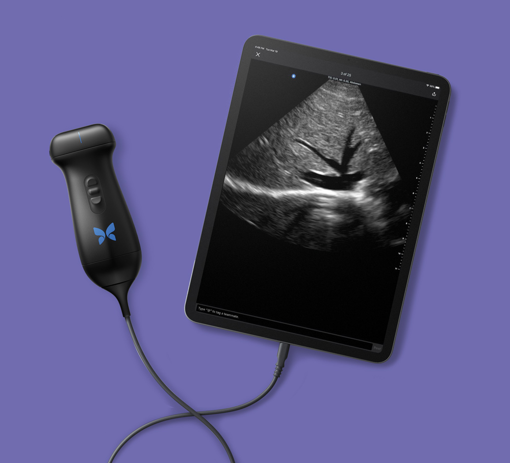 Échographe portable Butterfly iQ3 connecté à une tablette affichant une image échographique